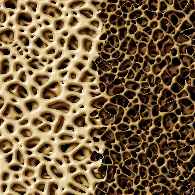osteoporosisweb